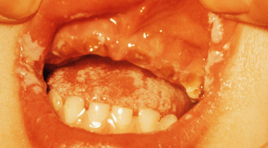 一个不能轻忽的感染，皮肤真菌感染的药物治疗