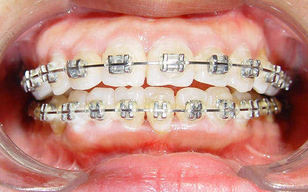 正畸过程全记录,正畸的几个阶段和步骤