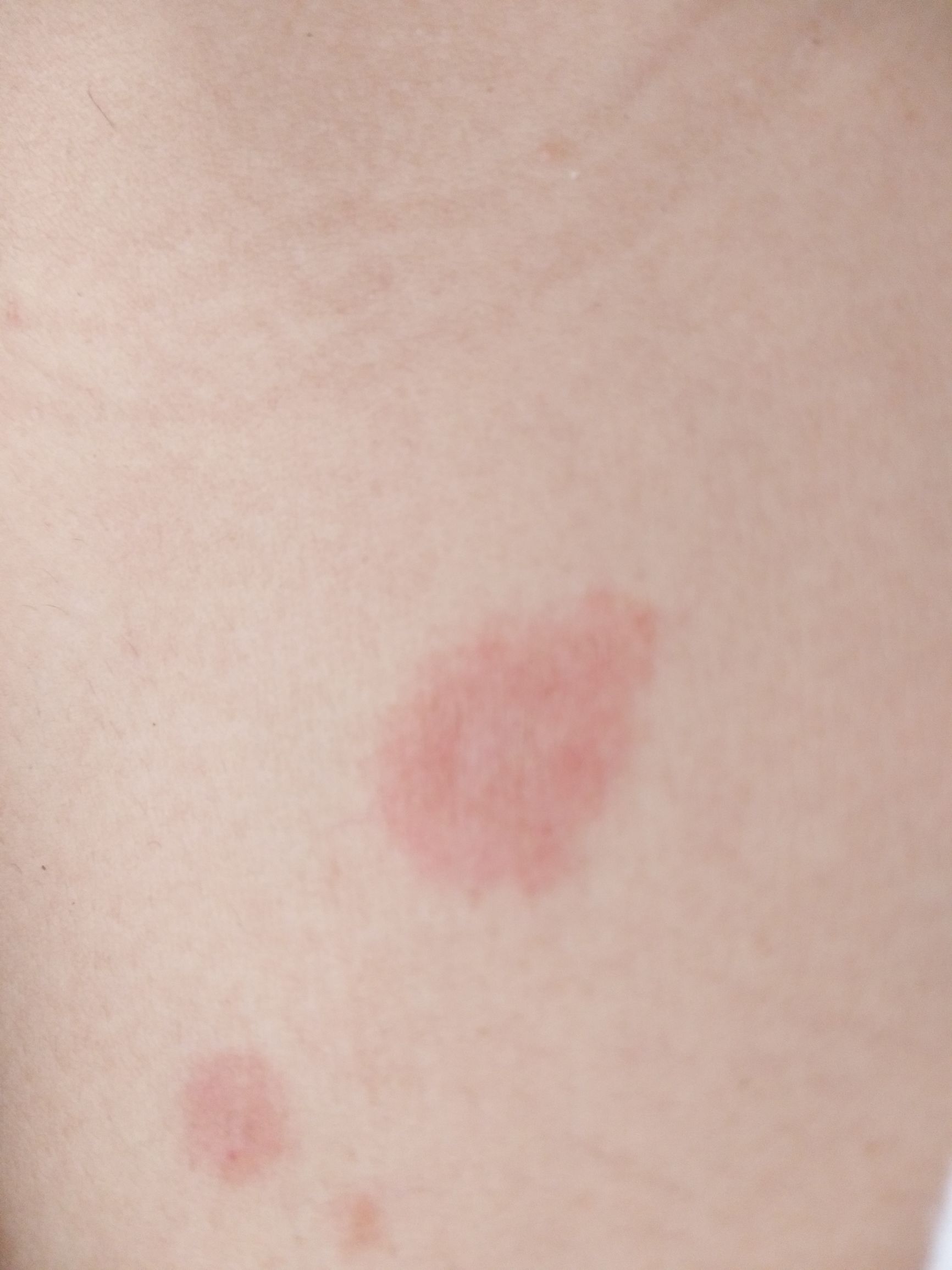 玫瑰糠疹有什么需要关注的,玫瑰糠疹自愈后还需要忌口吗