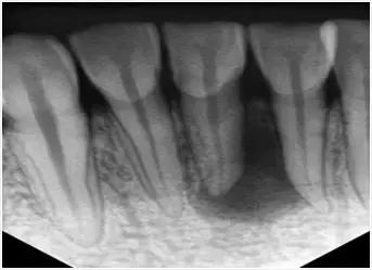 牙齿根管位置图解大全,牙齿需要治疗是什么意思
