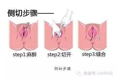 顺产妈咪最怕什么,侧切剖腹产孕妇要关注什么