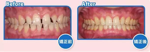 牙缝大的人漏财,牙缝变大有漏财说法吗