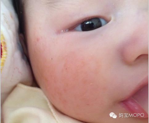 湿疹“大难题”，这些应对技巧请收好