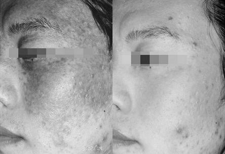 健康知识如何去脸部黑斑,清除脸褐斑吃什么