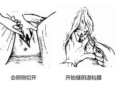 生孩子一定要外阴侧切吗,生孩子做侧切几率大吗