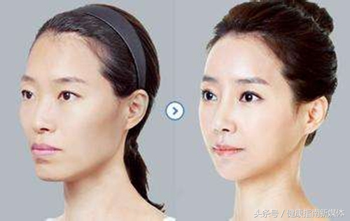 瘦脸针科普,水光针跟瘦脸针有什么区别
