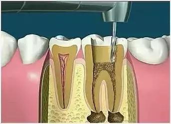 牙齿根管位置图解大全,牙齿需要治疗是什么意思