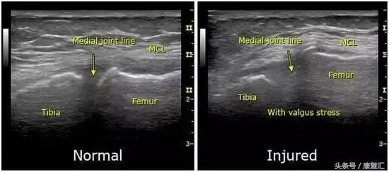 左膝关节内侧副韧带撕裂怎么锻炼,膝关节内侧副韧带损伤如何恢复