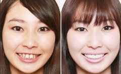 烦恼，丑死了！牙齿“长歪”了该怎么办？不用怕！牙科专家支妙招