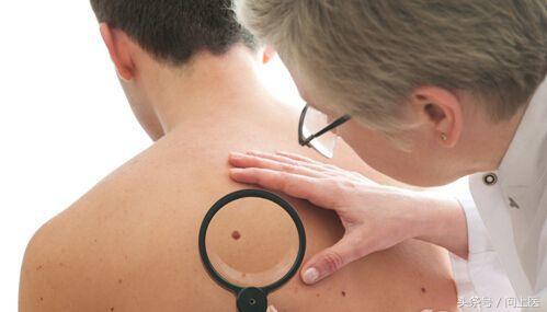 黑色素瘤的癌症早期有哪些症状,9种癌症早期症状早发现早识别