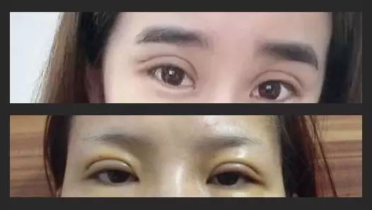 好看的双眼皮必须具备以下几点,真正做的好看的双眼皮是什么样子