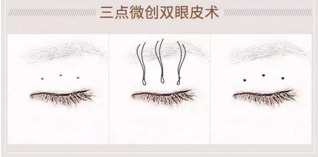 好看的双眼皮必须具备以下几点,真正做的好看的双眼皮是什么样子