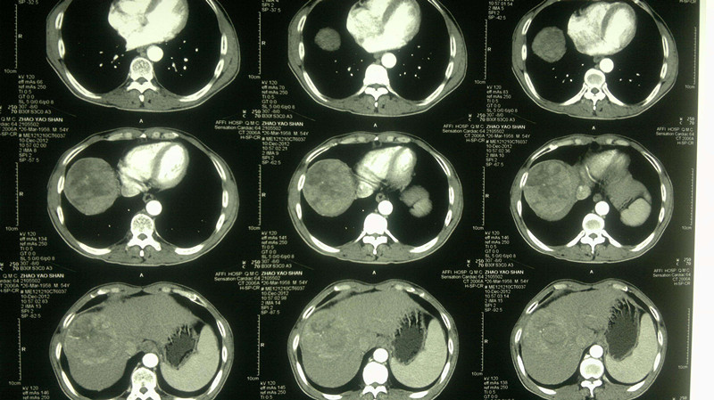 按一下肚子会发出水声？逃离不了这6种情况，病理性积水需谨慎