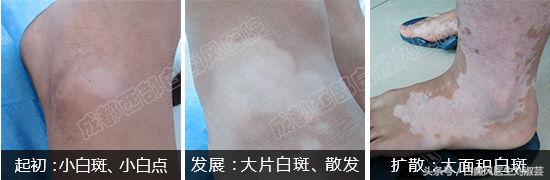 太阳晒后出现白癜风怎么修复,太阳晒伤会得白癜风吗