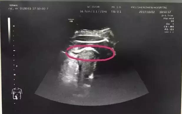 怀孕8月，胎儿竟一脚“踢”破子宫！原来是它惹的货！