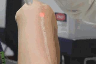 黑痣会有癌变的风险吗,黑痣会癌变吗怎么办