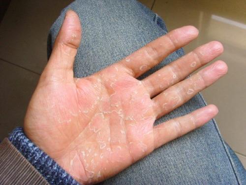 秋天手脱皮怎么办,深秋初冬手脱皮是为什么