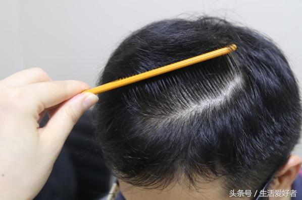 掉头发不长了怎么办,掉头发严重不长了怎么回事