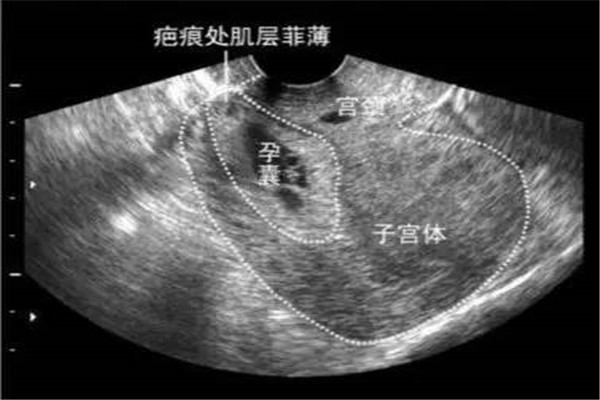 8个月胎儿踢妈妈视频,八个月的孕妇已经学会跆拳道