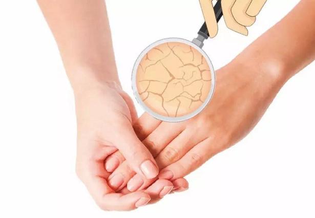 秋天手脱皮怎么办,深秋初冬手脱皮是为什么