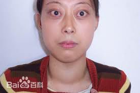 眼球凸出眼睛是变大还是变小,眼球正常是凸出来多少