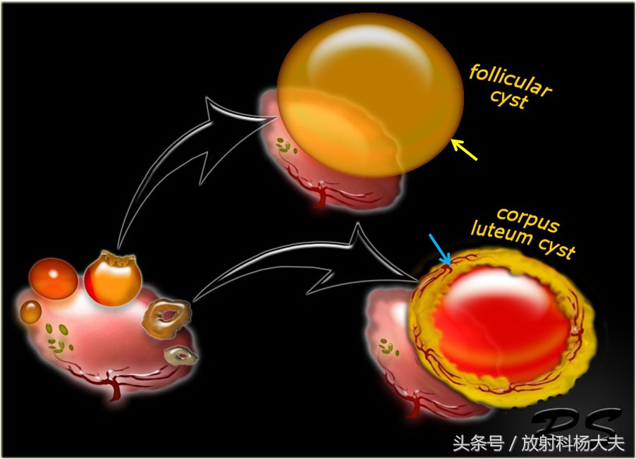 核磁上这种卵巢囊肿的壁血供丰富，属于良性，需谨慎外力撞击破裂