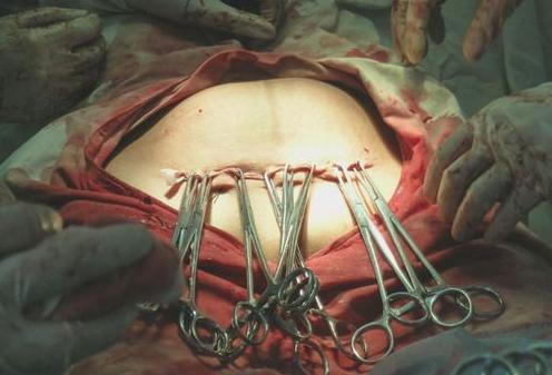 剖腹产后伤口用什么药不易留疤,剖腹产后刀疤为什么会发炎