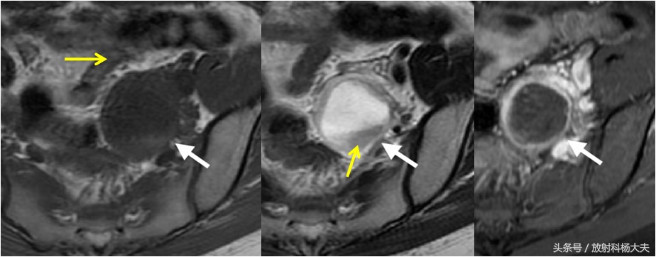 核磁上这种卵巢囊肿的壁血供丰富，属于良性，需谨慎外力撞击破裂