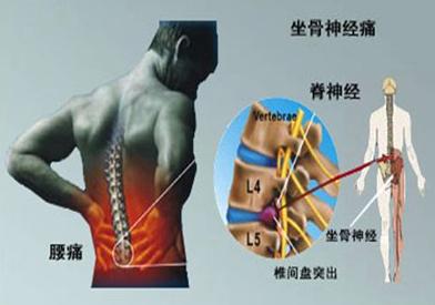 怎样治疗腰椎间盘突出呢,怎么治腰椎间盘突出最好的方法