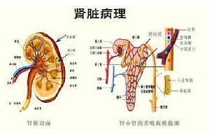 过敏性紫癜肾炎会引起尿毒症吗,过敏性紫癜会成尿毒症吗