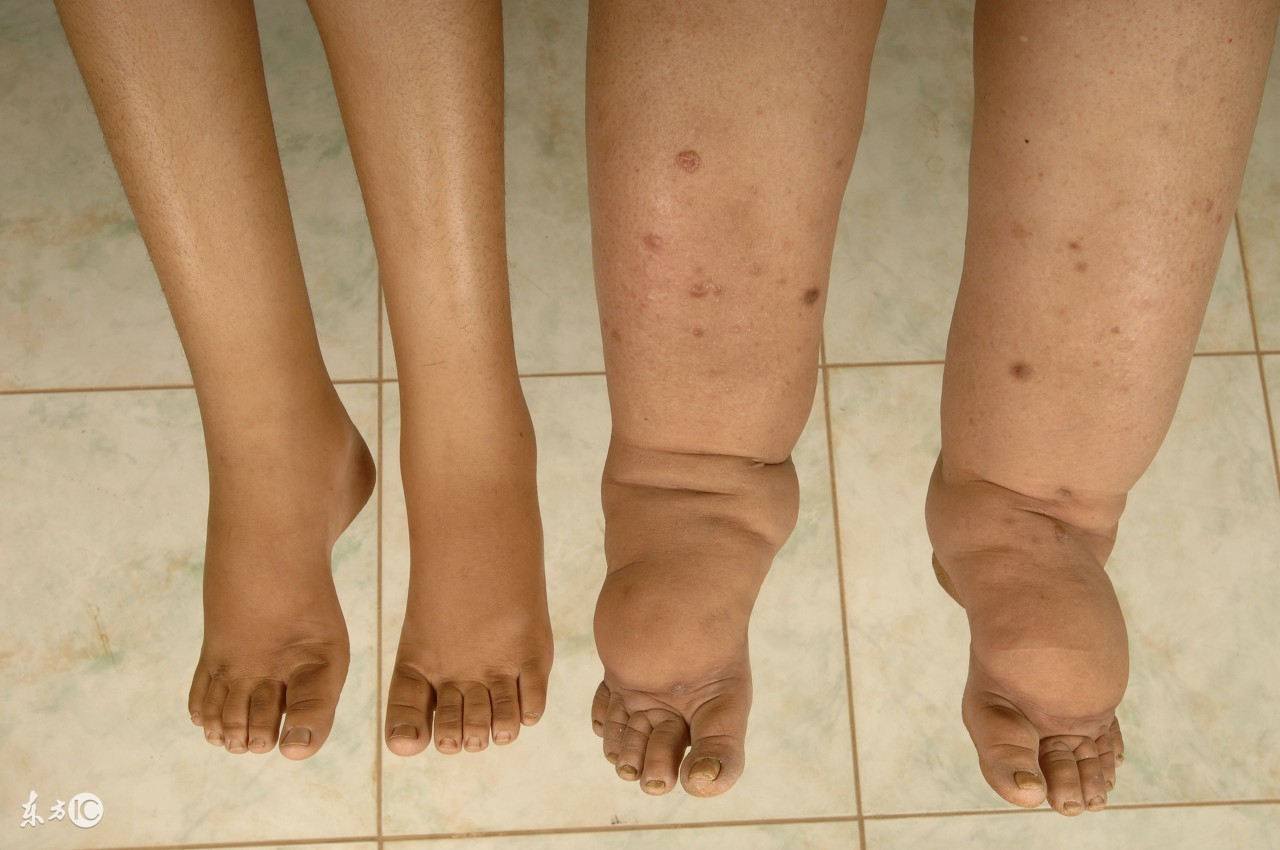 孕妇肿的跟个球一样怎么消肿,怀孕了下身长了肿包怎么回事