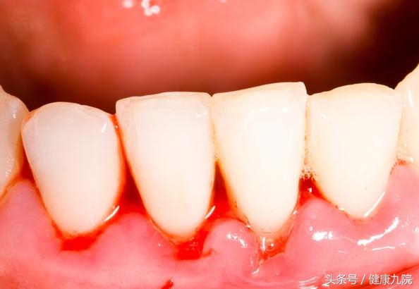 口腔长期出血是什么病征兆,经常口腔出血警惕四种病