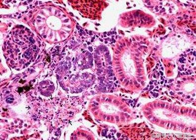 iga肾病导致尿毒症可以肾脏移植吗,iga肾病如何引起