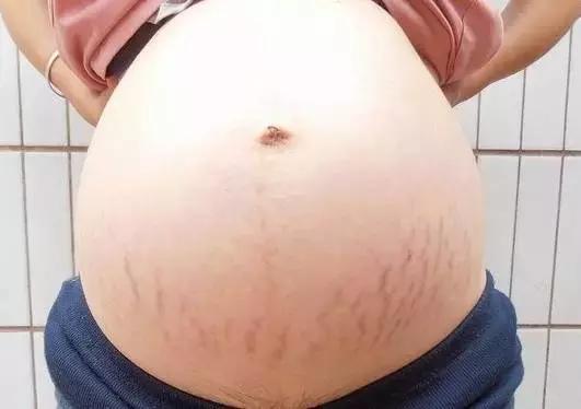辣妈孕期护肤秘诀,宝妈们都怎么去除妊娠纹
