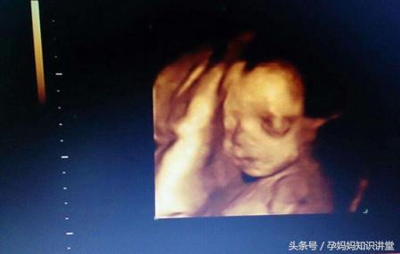 拍四维彩超让关注左肾情况,做四维彩超需要关注什么