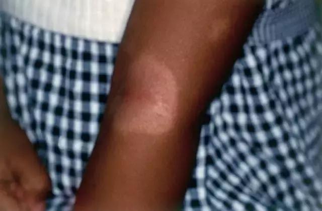 胎记及早治疗,胎记不治有什么后果