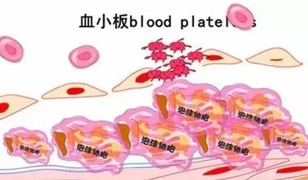 血小板减少迁延不愈可以吗,原发性血小板减少症治愈会复发吗