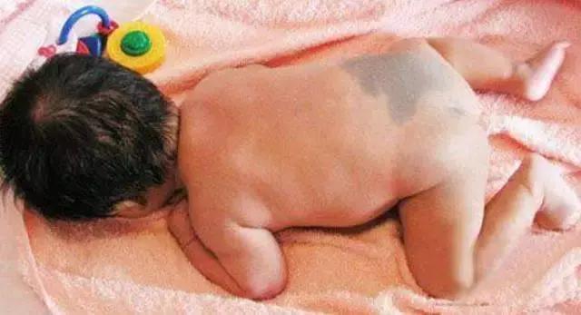 胎记及早治疗,胎记不治有什么后果