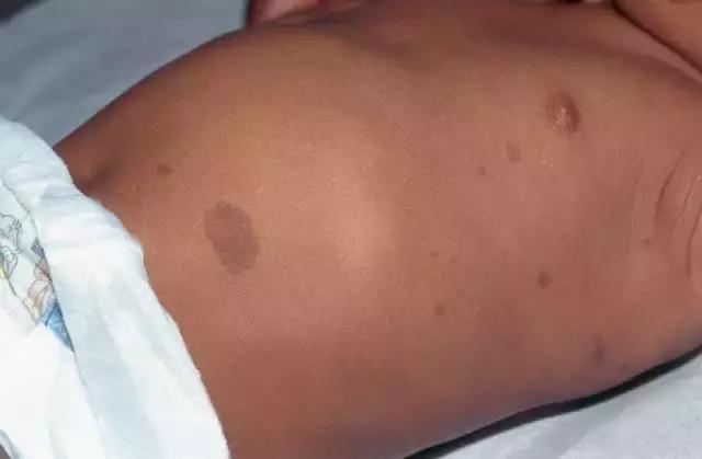 胎记及早治疗,胎记不治有什么后果