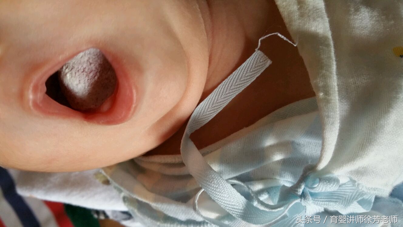 宝宝嘴巴外面白白的是怎么回事,宝宝嘴巴旁边有白白的一片是什么