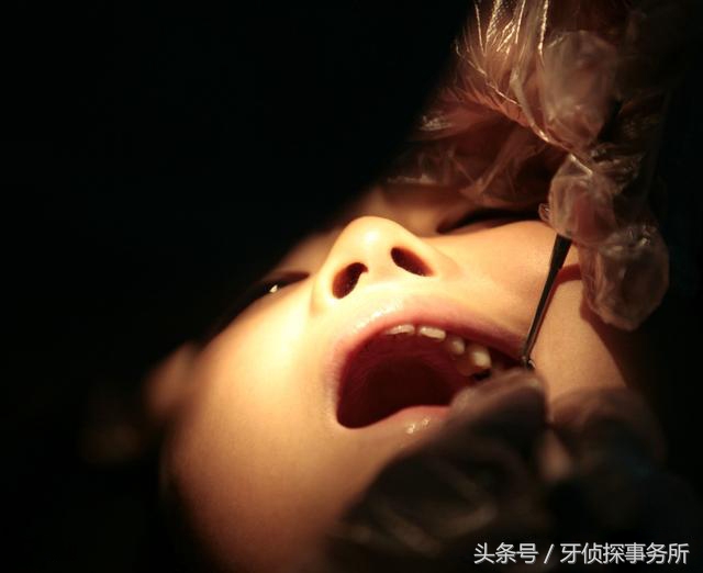 换牙前蛀牙有龋洞需要治疗吗,蛀牙形成需要多久