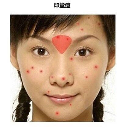 「看图识别长痘原因」还在苦恼长痘，如何祛痘，点开此文绝不后悔