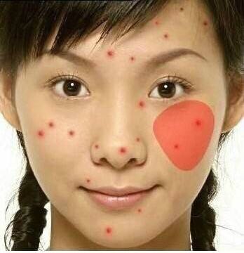 「看图识别长痘原因」还在苦恼长痘，如何祛痘，点开此文绝不后悔