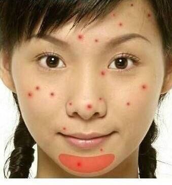 「看图识别长痘原因」还在苦恼长痘，如何祛痘，点开此文绝不后悔