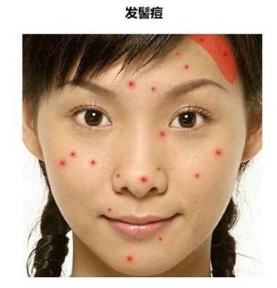 「看图识别长痘原因」还在苦恼长痘，如何祛痘，点开此文绝不后悔