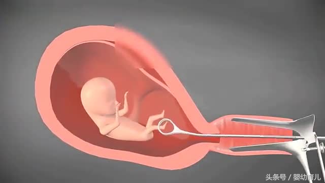 人工流产的胎儿会变成什么样,人工流产胚胎会不会活