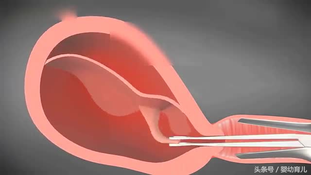 人工流产的胎儿会变成什么样,人工流产胚胎会不会活