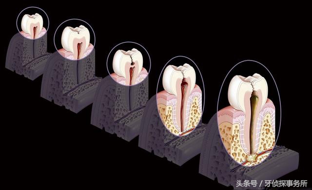换牙前蛀牙有龋洞需要治疗吗,蛀牙形成需要多久