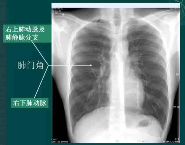 读完该文，让你学会如何看胸片