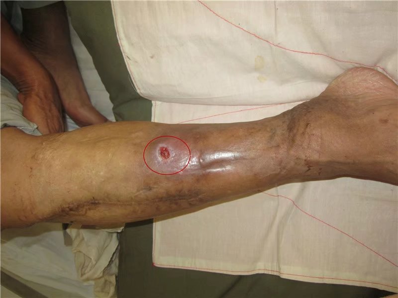 吃海鲜真的会复发病吗,吃海鲜会得癌症